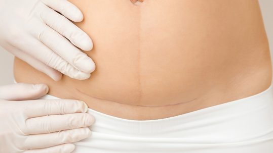 lifting de pubis