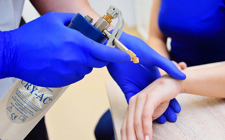 tratamiento crioterapia